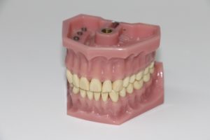 Picture of Full Set of Dentures Out of Mouth